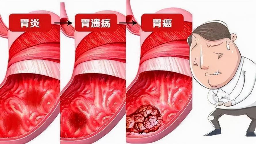 胃溃疡孕妇如何护理?